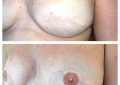 notice on these before + after images the scar running through the middle of the chest area. This is almost completely camouflaged by the eye being taken away and focussed on the 3D areola created by Vicky martin using her world famous Vicky martin Method® (VMM®)