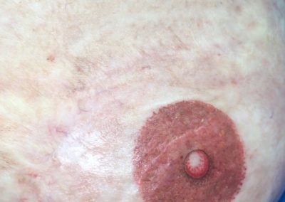 Damaged burned scarred skin from a childhood accident and having gone through breast cancer and reconstruction & treatments coming through the other side and now has areola for the first time since she was six years old