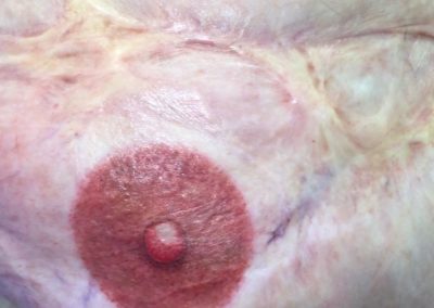 Damaged burned skin from a childhood accident and having gone through breast cancer and reconstruction & treatments coming through the other side and now has nipple for the first time since she was 6 years old