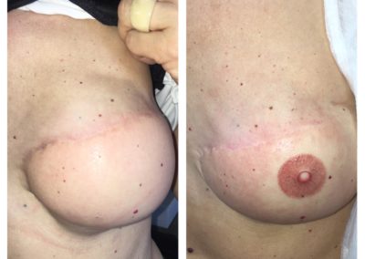 The amazing photos of 3d areola displaying before and after pictures of the VMM® technique