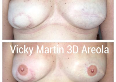 Before and after pictures micropigmentation photos after treatment and recovery from breast cancer by brave strong women