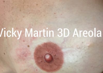 This is a detailed close up VMM® 3d nipple tattooing technique and results that can be expected to be achieved following reconstruction after having breast cancer an enduring the treatments and therapies following the illness. Tis is the completion of that journey and start of the journey forward into a fresh cancer-free life