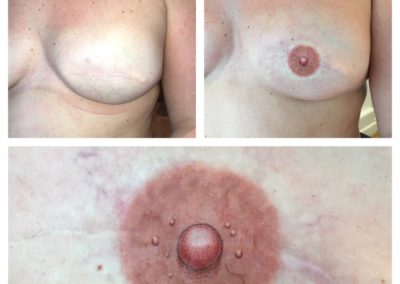 These photographs show Vicky Martin's before after and close up of Vicky's 3D areola VMM® method
