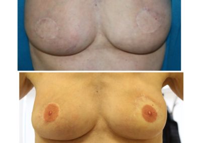 B4 & After 3D areola micro pigmentation VMM® technique. Making this lovely survivor of breast cancer feel whole again and putting back what breast cancer took away