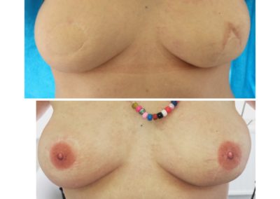 B4 and after double 3D areola work of Vicky Martin. This was a double reconstruction following a tough journey fighting breast cancer. nipples were removed and then replaced making this lovely lady feel like a woman again!