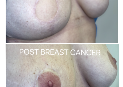 vmm areola on flat skin Before Vs After up to the other nipple. Not only have Vicky Martin created a 3D nipple but she has also matched up colours, shape and size to the other original untouched areola