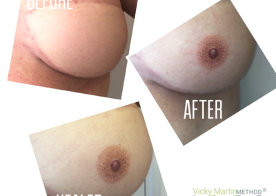 Vicky Martin strikes again with her amazing VMM® 3D Areola / nipple method. Here you will seeBefore after and healed 3D Areola results by Vicky Martin