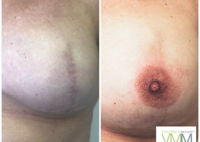 This transformation photograph demonstrates how life-like Vicky's VMM® 3D Areola technique really is transformation photograph has been created via micro-pigmentation (medical tattooing) this shows the skin canvass before and after Vicky Martin has created these perfect and natural looking 3D nipples!