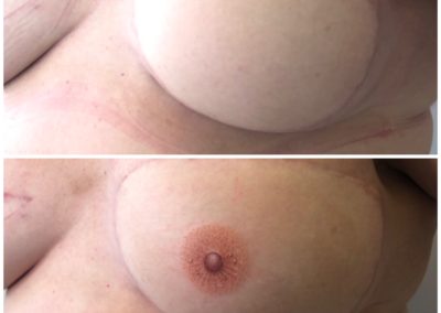 Before and After picture of the VMM® 3D Areola and After picture of the VMM® 3D Areola following recovery from breast cancer and mastectomy. This nipple tattoo is the first steps to feeling like a woman again for most ladies
