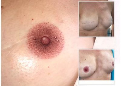 Close up Before and after pictures of Vicky Martin's 3D areola VMM® technique up and frontal view of Vicky Martin's VMM® 3D technique following this lady having had breast reconstruction showing whats available after surgery