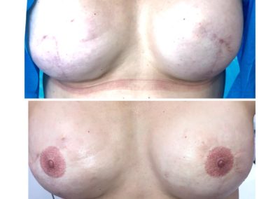 Before and after picture of Vicky Martin's 3D areola Vicky Martin Method VMM® technique before and after seeing Vicky Martin for her VMM® method and the 3D effect that is created so cleverly