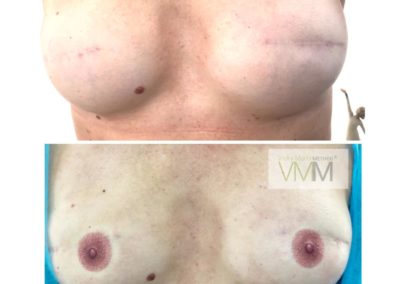 Before and after picture of Vicky Martin's 3D areola VMM® technique VMM® no areola to 3D amazing areola method