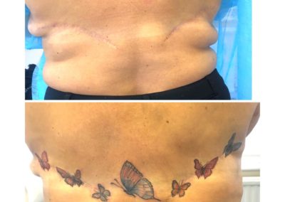 Cover up of scars. Vicky Martin's beautiful butterflies camouflaging scars following breast reconstruction pre and post pictures of Vicky's cover up tattooing work that she offers ladies to camouflage scarring after breast reconstruction